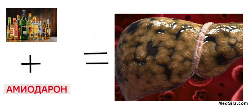 Алкоголь+амиодарон=печеночная недостаточность